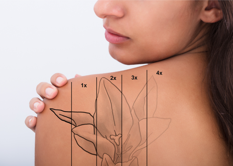 Comprar láser para quitar tatuajes